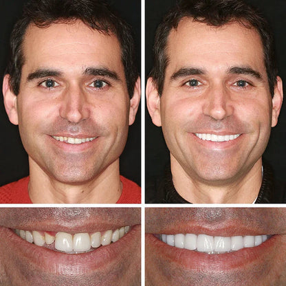🌈Ends Today: 70% OFF! ⏰HazyGalaxy™  Medical Full Denture with Strong Suctiond Custom-Fit Full Functional Dentures🦷